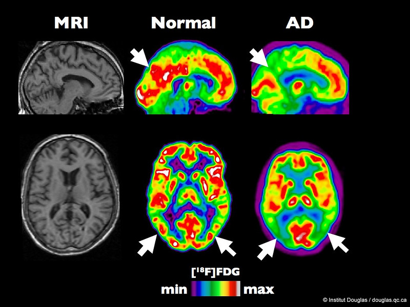 A brain scan of a person without Alzheimer's and a person with Alzheimer's.