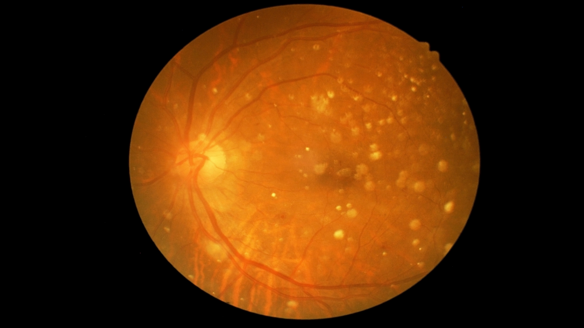 Visualization of macular degeneration showing the damage to the retina's central region, known as the macula, leading to impaired central vision.